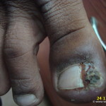 A Case of Felon at toe nail cured by Homeopathy
