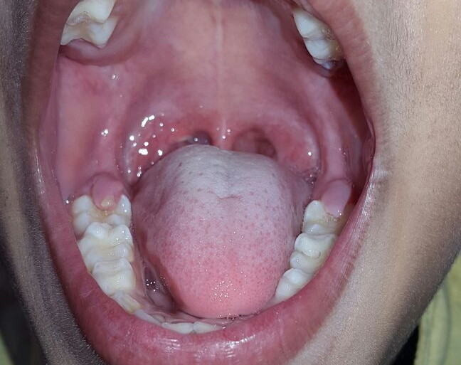 A case of Lacerated Tongue