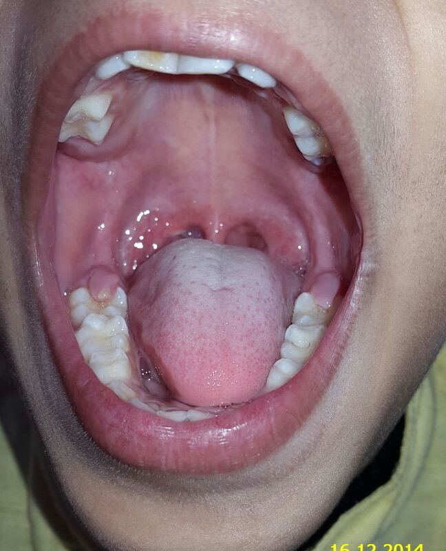 A case of Lacerated Tongue