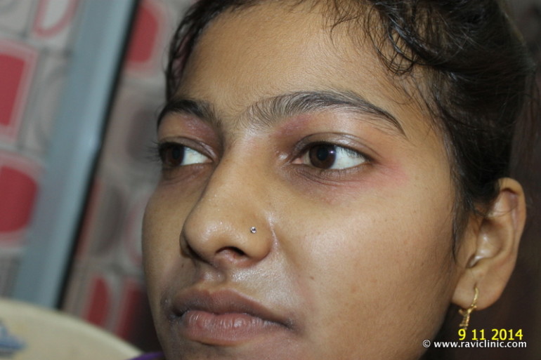 A Case of Air Born Contact Dermatitis cured by Homeopathy