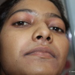 A Case of Air Born Contact Dermatitis cured by Homeopathy