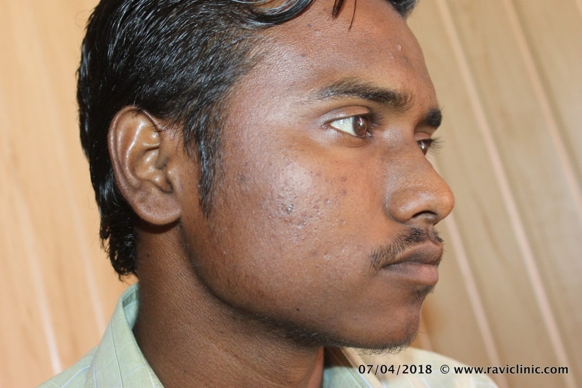 A case of Acne cured by Homeopathy