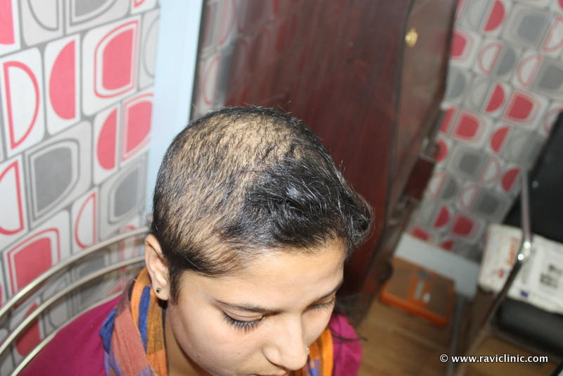 Hair Fall Since Two Years Cured