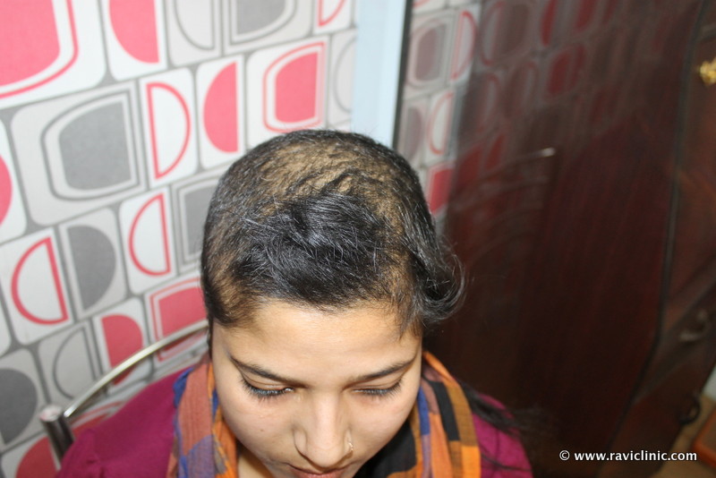 Hair Fall Since Two Years Cured