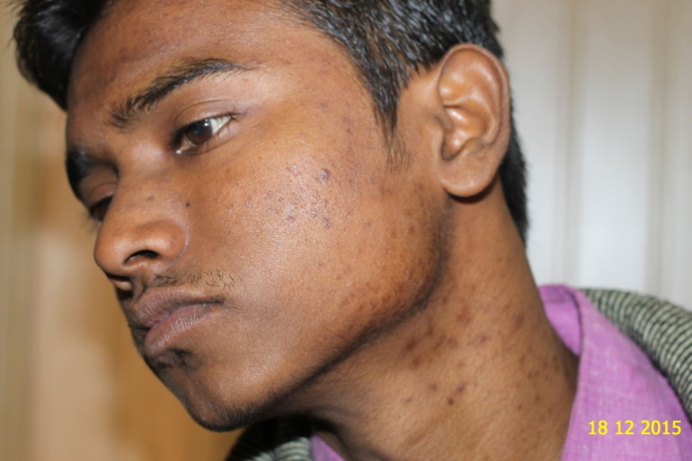 A case of Acne cured by Homeopathy