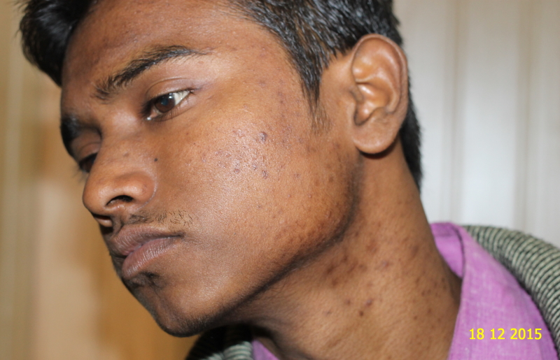A case of Acne cured by Homeopathy – Homeo Energy