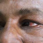 A case of Frequent Eye Allergy Episcleritis