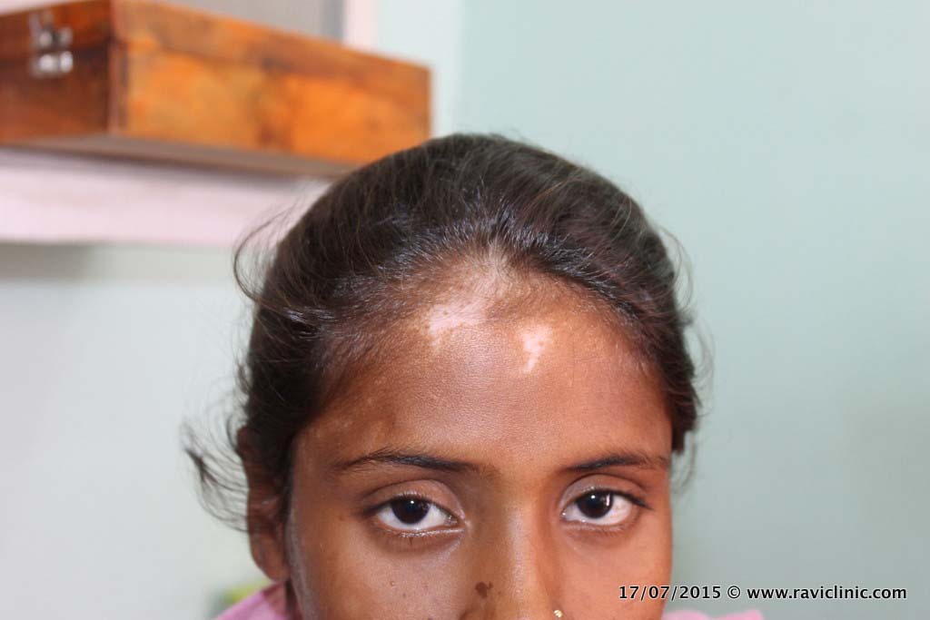 Vitiligo On Face