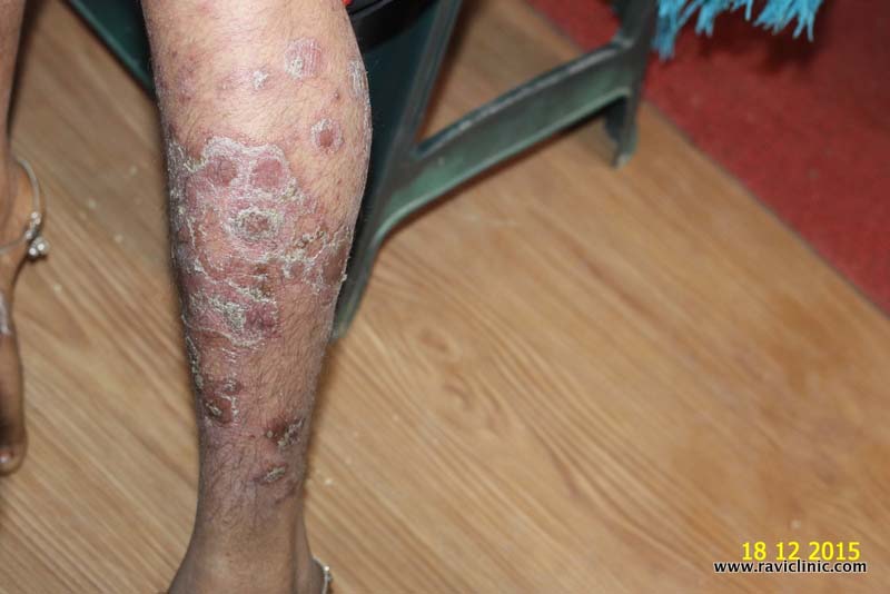 Psoriasis since many years