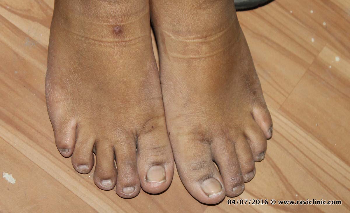 Psoriasis Feet in young girl