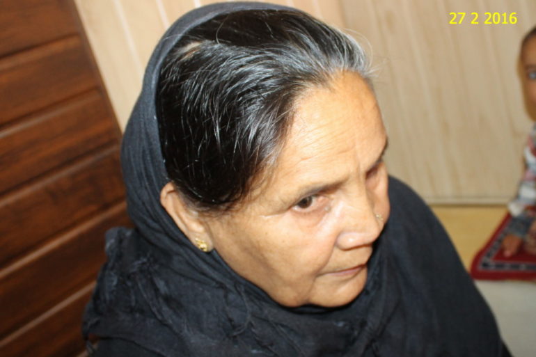 Alopecia Areata In old Lady