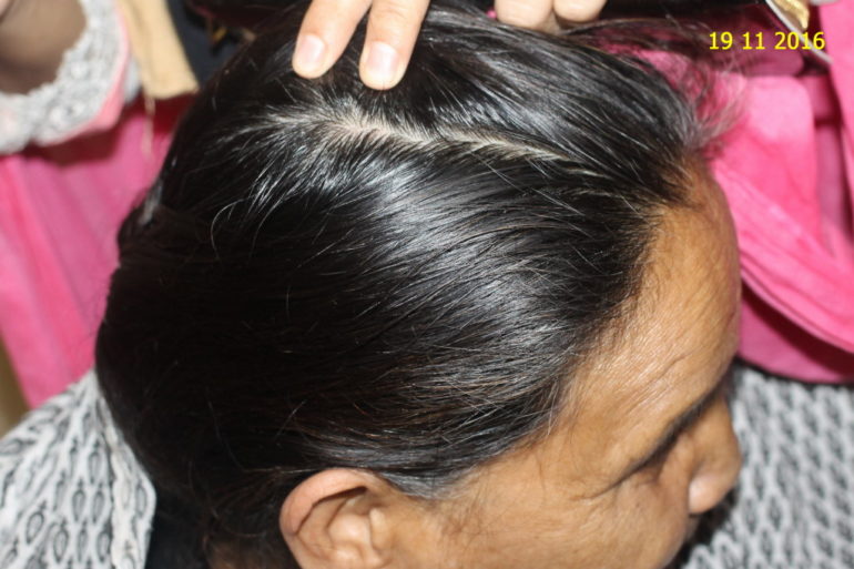 Alopecia Areata In old Lady
