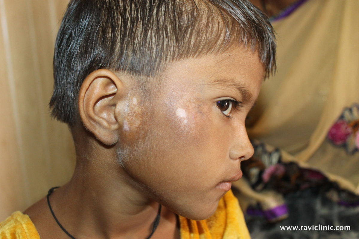 A case of Vitiligo on Face due to Eruptions