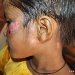 A case of Vitiligo on Face due to Eruptions