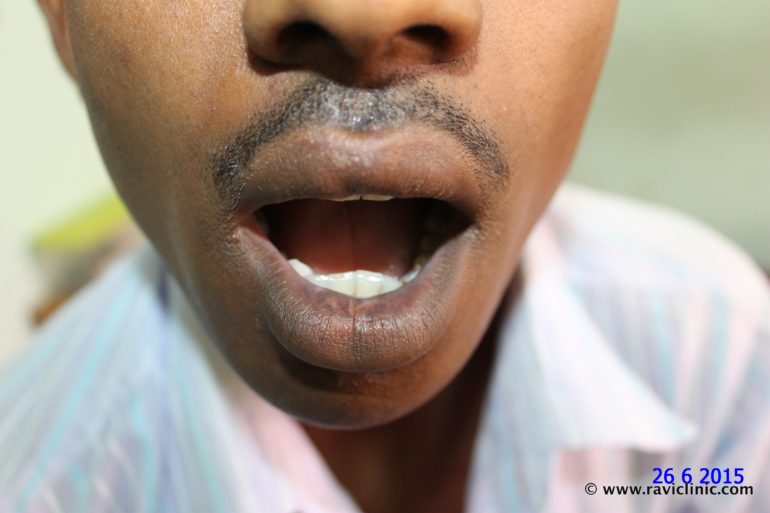 A case of Vitiligo on Lips