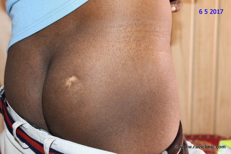 Vitiligo and Hypothyroidism in Young Boy
