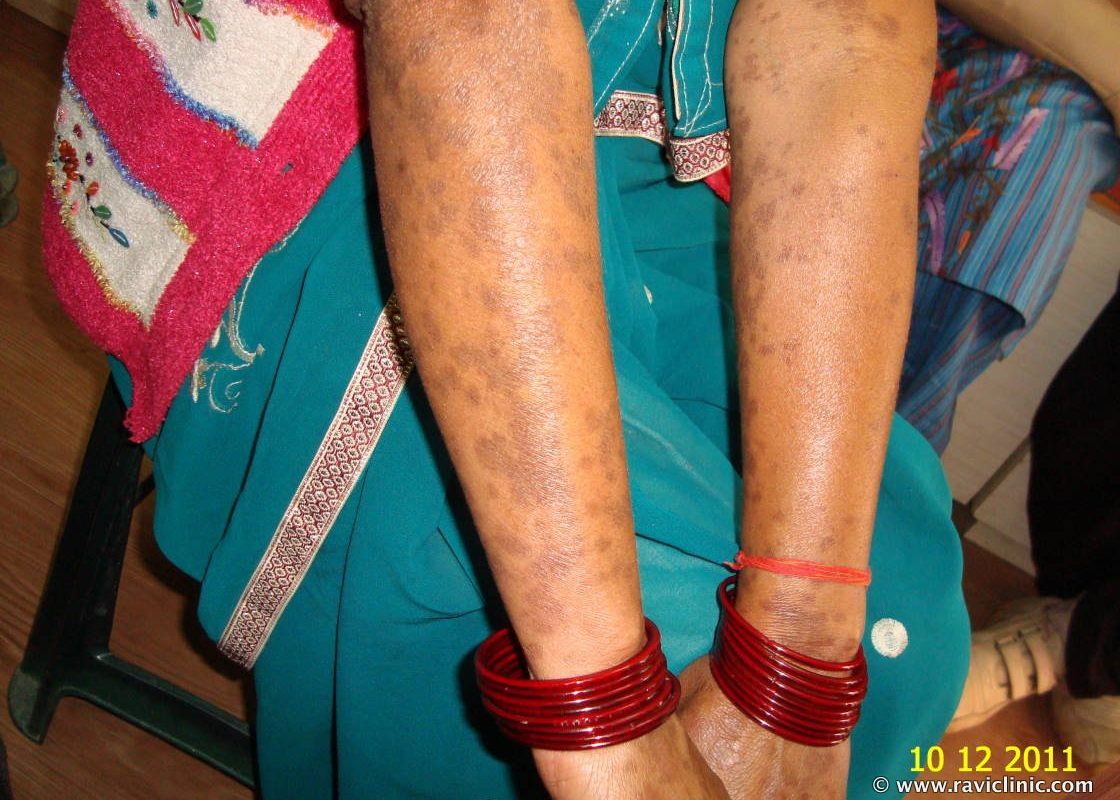 Lichen Plannus In Young Lady Cured by Classical Homeopathy