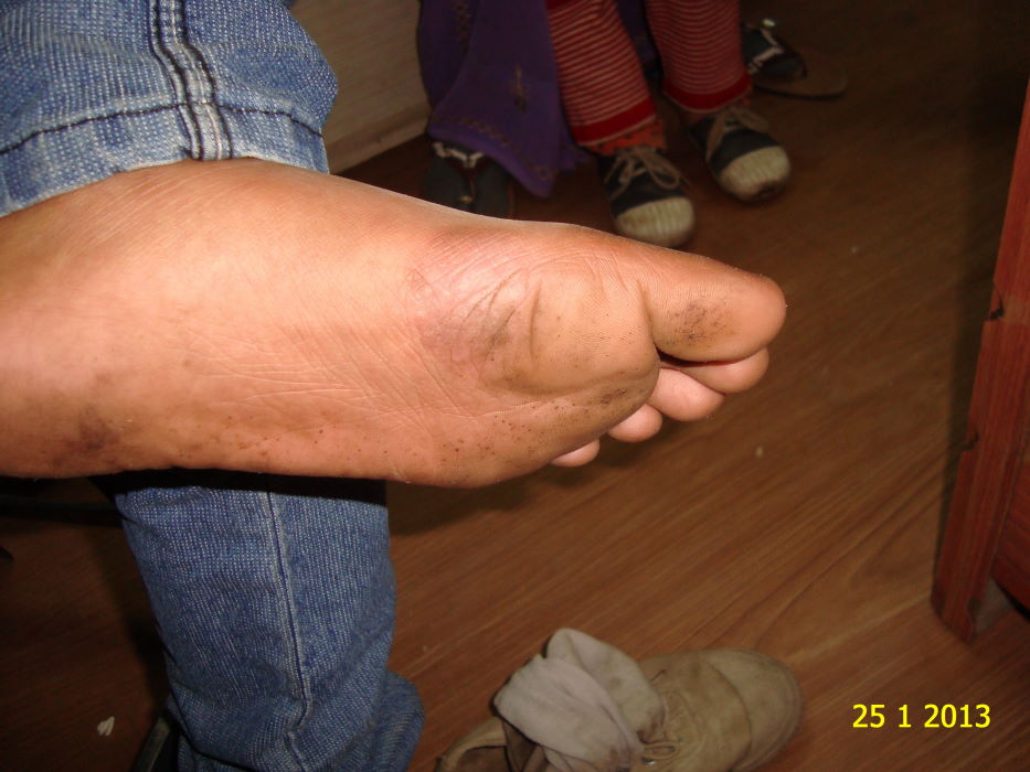 Psoriasis at Feet