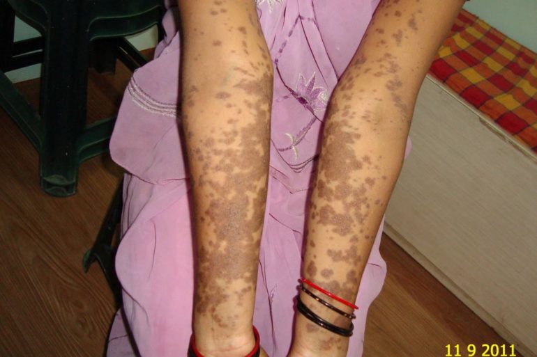 Lichen Plannus In Young Lady Cured by Classical Homeopathy