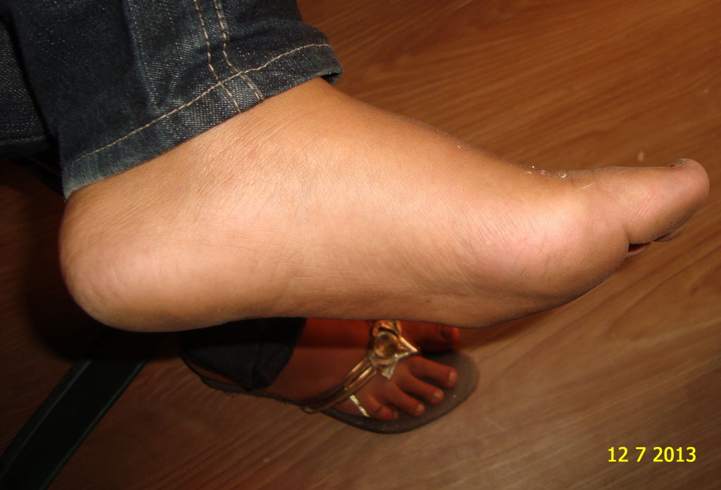 Psoriasis at Feet