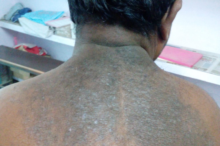 A Case of skin eruption on back