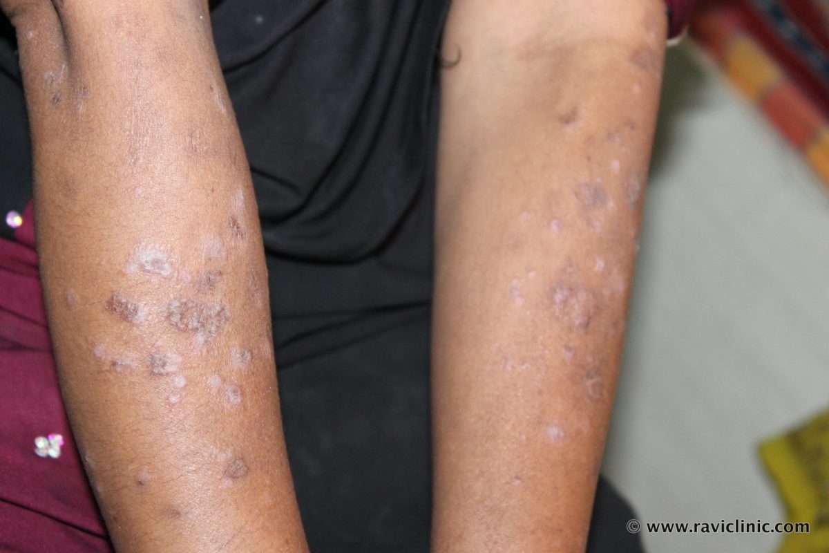 A case of Lichen Plannus in A lady Cured By Homeopathy