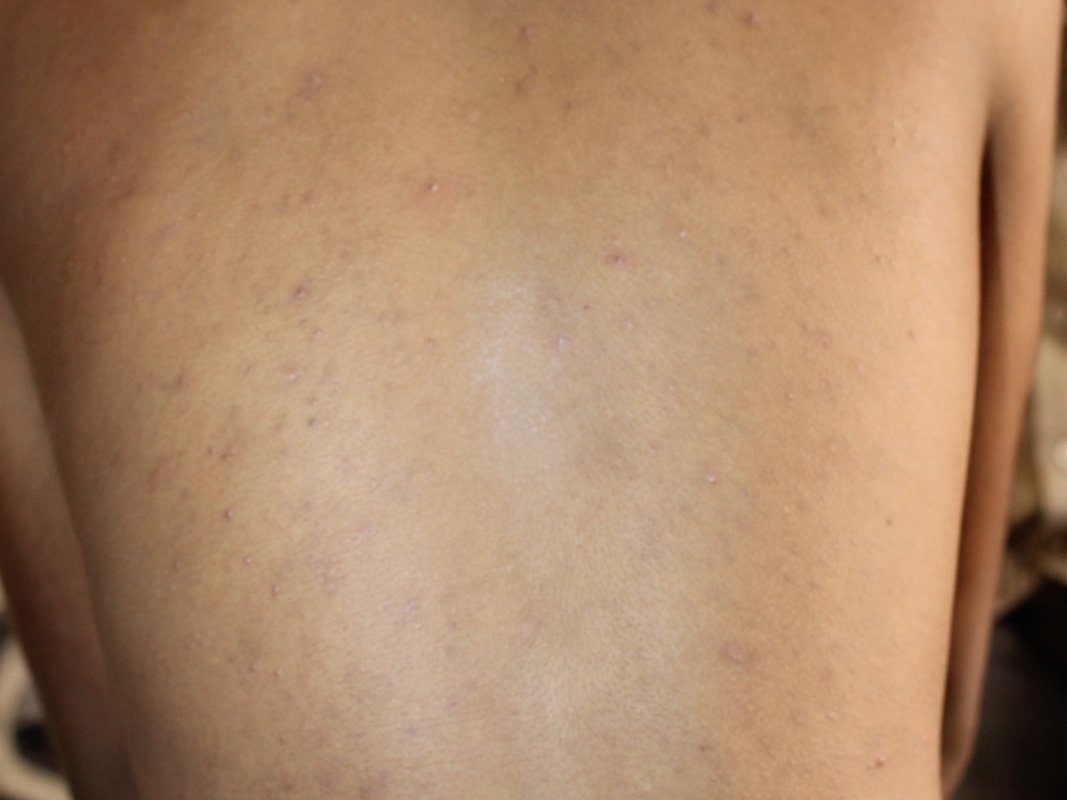 A Case of Pompholyx or Dyshidrosis and Acne 11 years followwup.