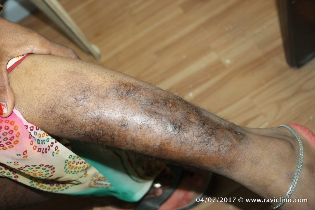 A case of Psoriasis Since Years Cured