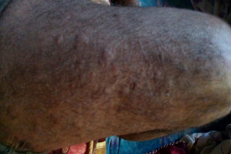 Chronic Urticaria Patient Who has already taken 1500 tablets of Citrazine