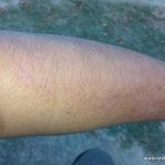 Chronic Urticaria Patient Who has already taken 1500 tablets of Citrazine