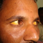 A case of Jaundice from Mumbai Serum Bilirubin 14.17