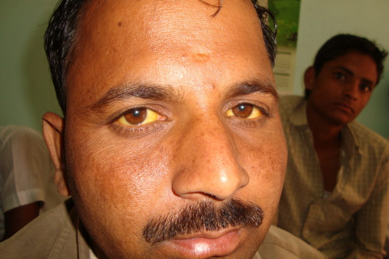 A case of Jaundice from Mumbai Serum Bilirubin 14.17