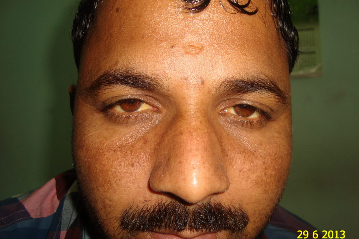 A case of Jaundice from Mumbai Serum Bilirubin 14.17