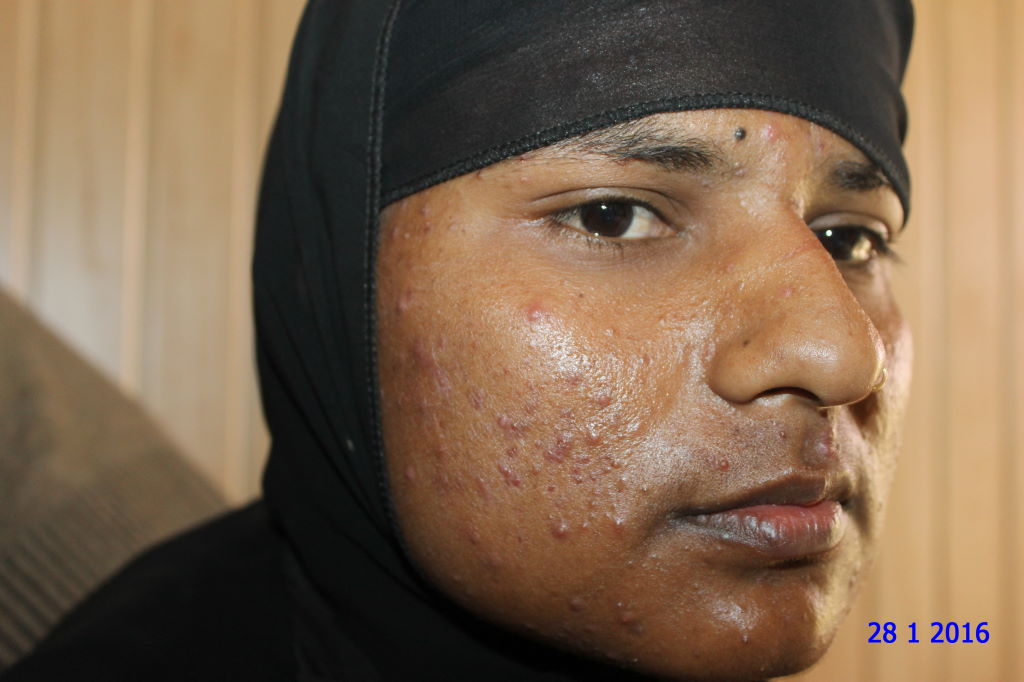 A case of Acne in Young Unmarried Girl