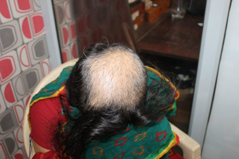 Trichotillmania  Hair Plucking Disorder