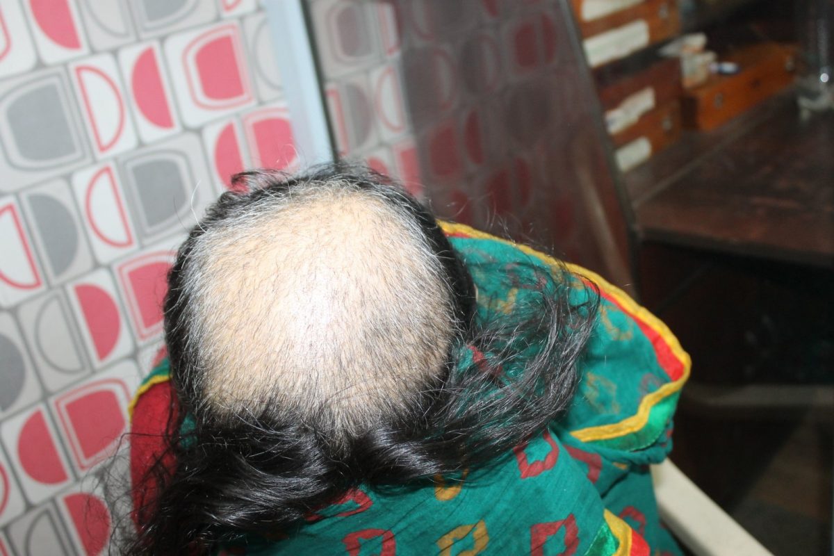 Trichotillmania  Hair Plucking Disorder