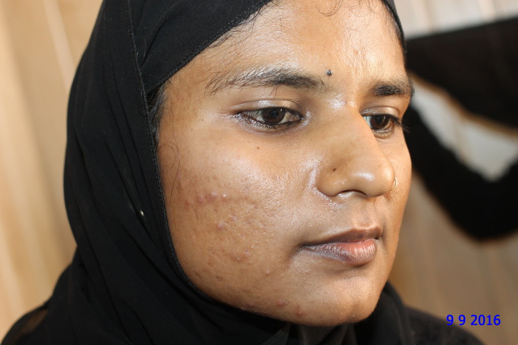 A case of Acne in Young Unmarried Girl