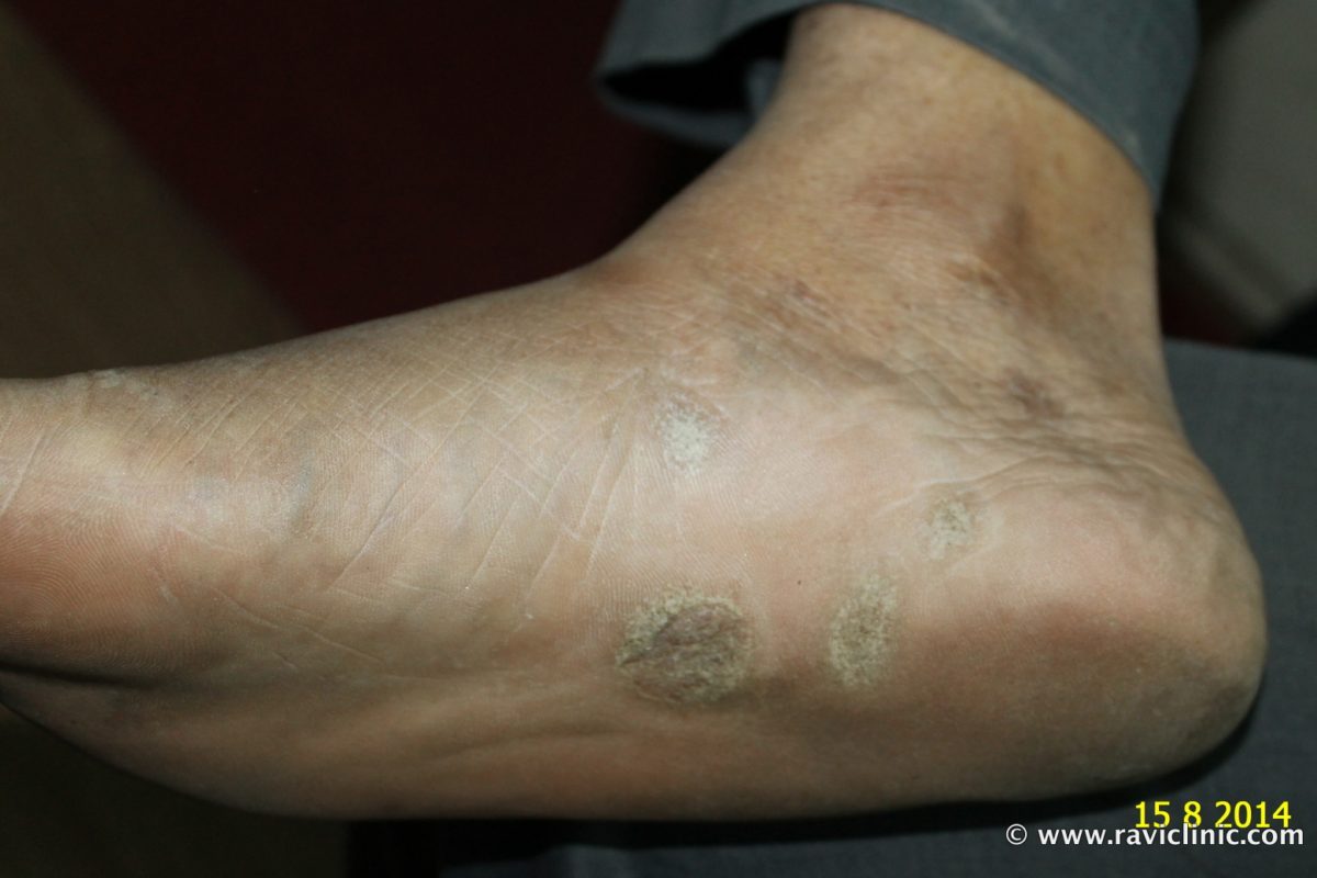A case of Psoriasis at Feet