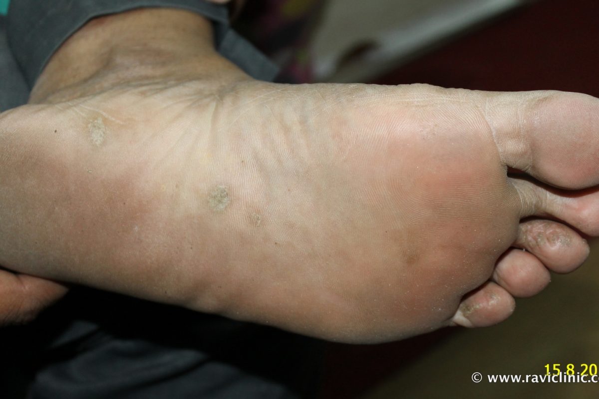 A case of Psoriasis at Feet