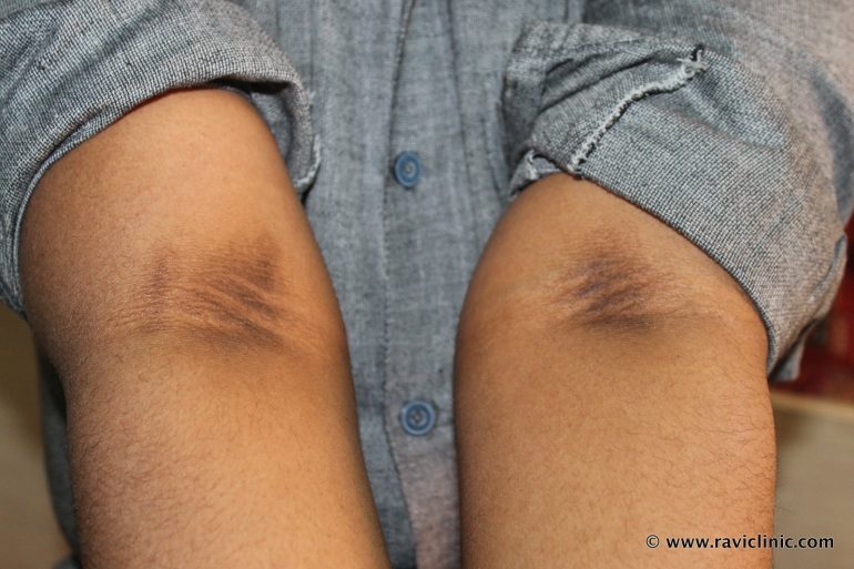 Acanthosis Nigricans Cured Case