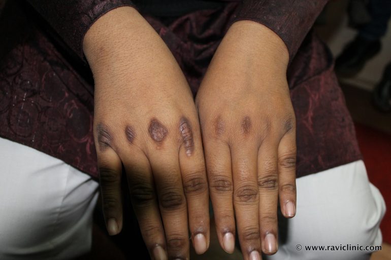 Acanthosis Nigricans Cured Case
