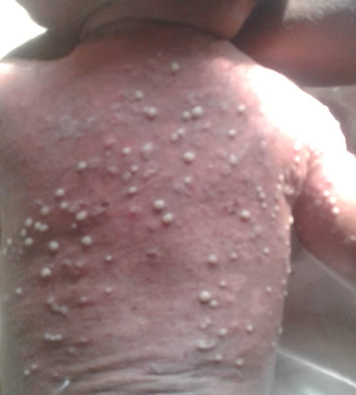 A case of Severe Staphylococcal Infection