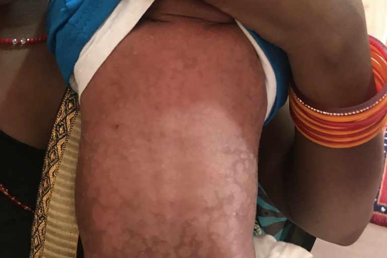 A case of Severe Staphylococcal Infection