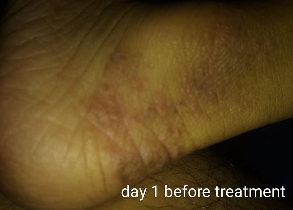 Eczema of 3 Years Cured by Homeopathy