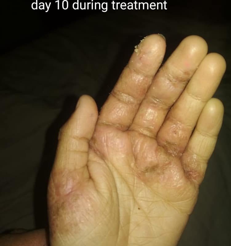 Eczema of 3 Years Cured by Homeopathy