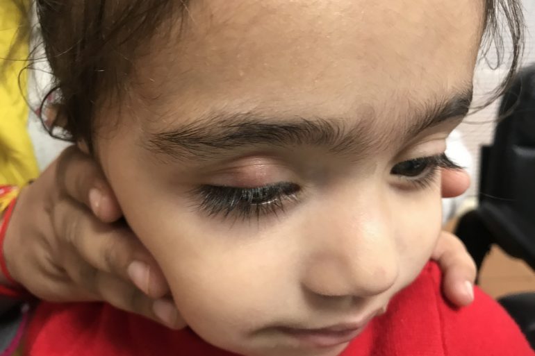 Case of Chalegion for 6 Months in a Child
