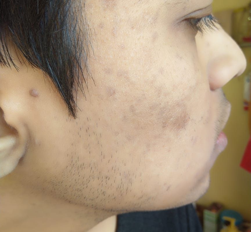 Flat warts for 9 years Getting cured