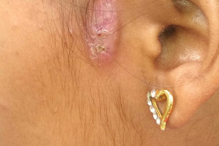 Pre Auricular Sinus For 2 years Getting cured