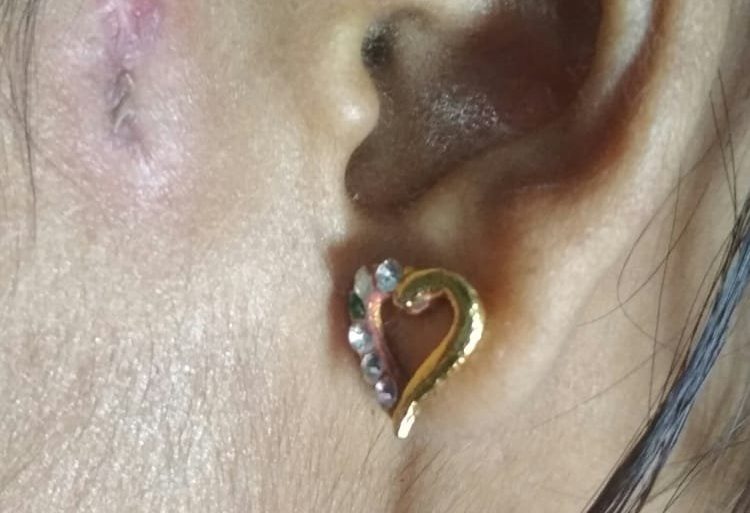 Pre Auricular Sinus For 2 years Getting cured