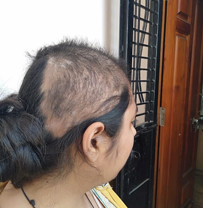 Trichotillomania Since 13 Years getting Cured